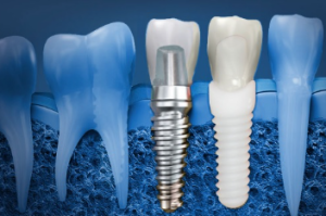 Unveiling the cost of dental implants canberra