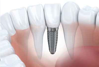 cost of dental implants in guyana