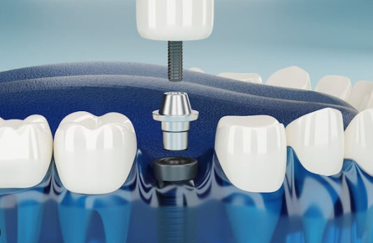 cost of dental implants in new zealand