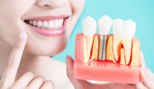 cost of dental implants in ontario