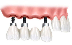 Reclaiming Your Smile: A Comprehensive Guide to cost of dental implants johannesburg