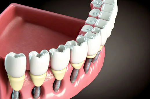 cost of full mouth dental implants in new york