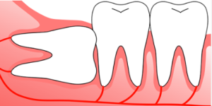 cost of tooth extraction in chennai