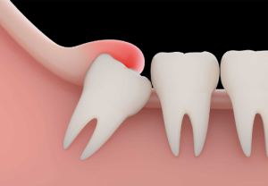 cost of tooth extraction in nigeria