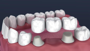 dental bridge cost in australia