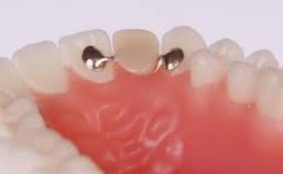 dental bridge cost in chennai