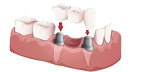 dental bridge cost in georgia