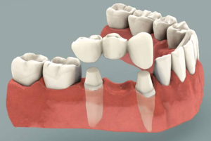 dental bridge cost in mexico