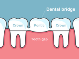 dental bridge cost in mumbai