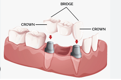 dental bridge cost in sri lanka