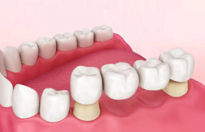 dental bridge cost new zealand