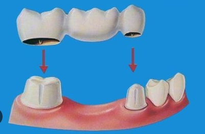 dental bridge cost south africa