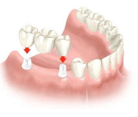 dental bridge cost spain