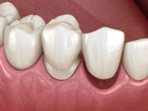 dental crown cost in australia