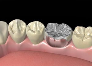 dental crown cost in japan