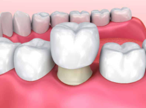 dental crown cost in thailand