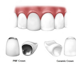 dental crown cost south africa