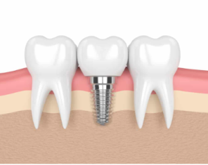 dental implants cost in australia