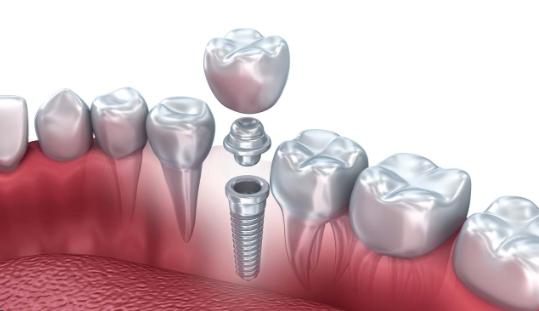 dental implants cost in ghana