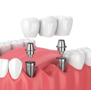 dental implants cost in mexico