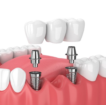 dental implants cost in mexico