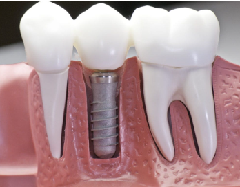 dental implants cost in mumbai