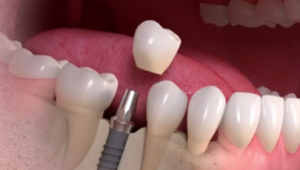 dental implants cost in tanzania