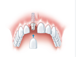 dental implants cost south africa