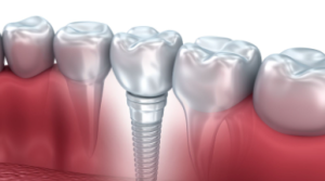 dental implants spain prices