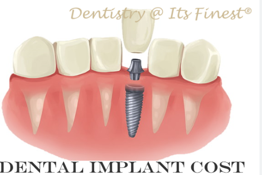 full mouth dental implants cost california