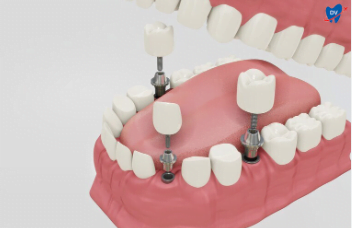 full mouth dental implants cost poland