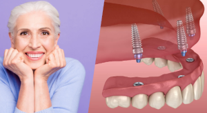 full mouth dental implants cost texas