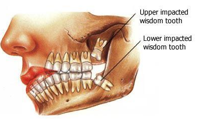 impacted wisdom tooth removal cost