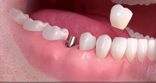 Unveiling the implant teeth in japan price