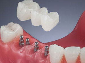 mini dental implants cost in india