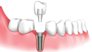 partha dental implants 32 teeth cost