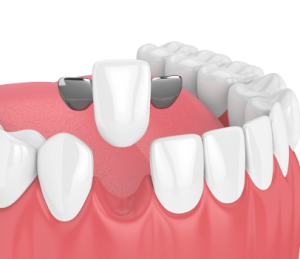 resin bonded bridge cost