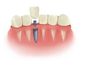 Unveiling the tooth bridge cost in japan: A Comprehensive