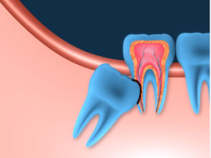 tooth extraction cost in australia