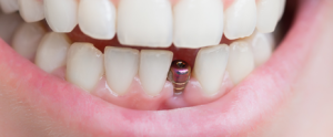 tooth implant cost in india in rupees