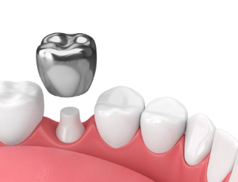 types of dental crowns and cost