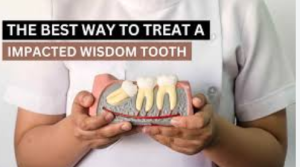 wisdom teeth removal cost in mexico