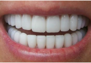 zirconia crown cost in pune