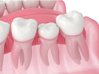 $40 Tooth Extraction in Hamilton