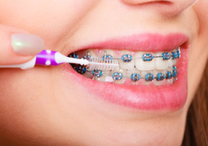 Ceramic Braces Cost in Coimbatore