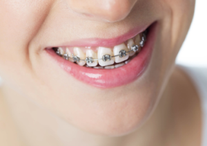 Ceramic Braces Cost in Dubai