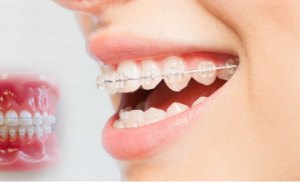 Ceramic Braces Cost in Jaipur