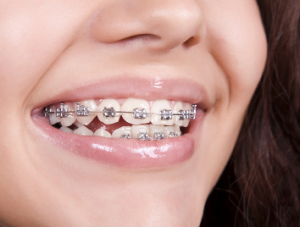 Ceramic Braces Cost in Nepal