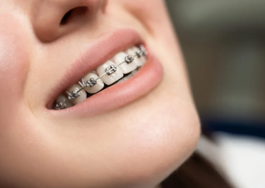 Ceramic Braces cost in Ahmedabad