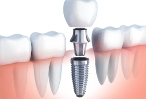 Cheap Dental Implants in Hungary